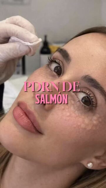 ¿El secreto para una piel perfecta está en el ADN del salmón? 🐟✨Si buscas una regeneración profunda, tienes que conocer el PDRN. No es solo hidratación; es un potente bioestimulador que trabaja a nivel celular para:
• Reparar células dañadas.
• Cerrar poros dilatados.
• Devolver la firmeza y luminosidad perdida.Utilizado por celebridades como Kim Kardashian y Jennifer Aniston, este tratamiento de vanguardia le da a tu rostro el “segundo aire” que merece. 💉💆♀️📩 ¿Quieres saber si eres candidata? Escríbenos por DM para una valoración.
#Salmon #poros #belleza