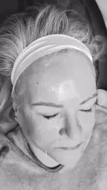 El secreto para una piel de seda no es un filtro, es Dermapen. ✨ Skin goals activados.Este tratamiento de inducción de colágeno es el aliado perfecto para renovar tu piel desde las capas más profundas.Di adiós a los poros abiertos y dale la bienvenida a una luminosidad natural que se nota desde la primera sesión.Dale a tu rostro el refresh que se merece con tecnología de punta.#dermapen #thebeautydoctors #facial