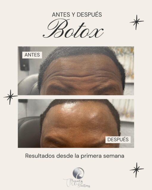 ¿Líneas de expresión muy marcadas? El cambio habla por sí solo. ✨En tan solo una semana, logramos suavizar la frente manteniendo un aspecto natural y descansado. No se trata de cambiar quién eres, sino de resaltar tu mejor versión y ganar seguridad en cada expresión.✅ Resultados visibles desde los primeros días.
✅ Procedimiento rápido y seguro.¿Listo para ver estos resultados en ti? Comenta BOTOX y te enviamos toda la información por DM. 📩#botox #salud #lineasdeexpresion