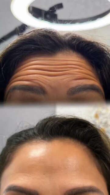 ✨ Say goodbye to expression lines ✨Check out these incredible before-and-after results from our Botox treatment. 😍 We managed to smooth out forehead wrinkles while maintaining a fresh, natural expression. 🌿Now is the perfect time to show off skin that looks younger and more radiant! ✨📲 BOTOX Available
📍 Book your appointment today via DM or through the link in our bio.#Botox #RealResults #FlawlessSkin #GoodbyeWrinkles #youthfulski