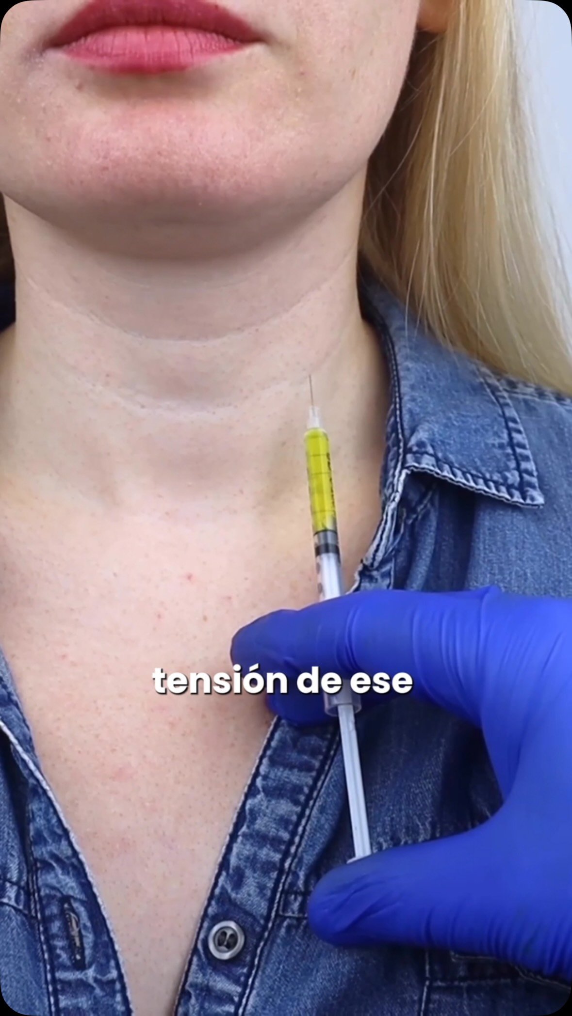 ¿Te miras al espejo y sientes que tu cuello ya no es el mismo? 👵✨No es falta de ejercicio, es el paso del tiempo marcando el músculo platisma. La buena noticia es que no tienes que resignarte.El Nefertiti Lifting es el tratamiento no quirúrgico que estabas buscando para redefinir el contorno facial y suavizar esas líneas. Recupera la firmeza que te hace sentir segura. 💖Escríbenos y agenda tu cita en The Beauty Doctors.#cuello #botox #thebeautydoctors #nefertitilifting